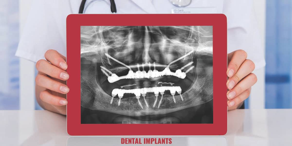 dental Imaplants